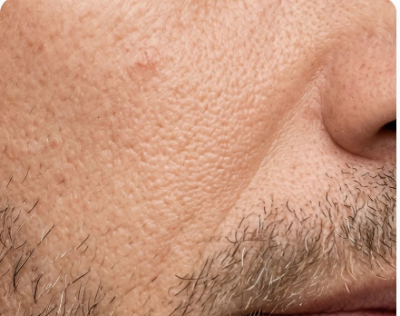 Piel Grasa